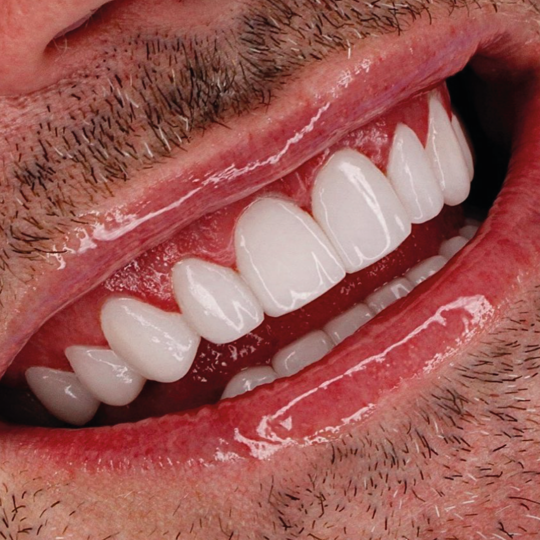 Smile design detail — Smile On result