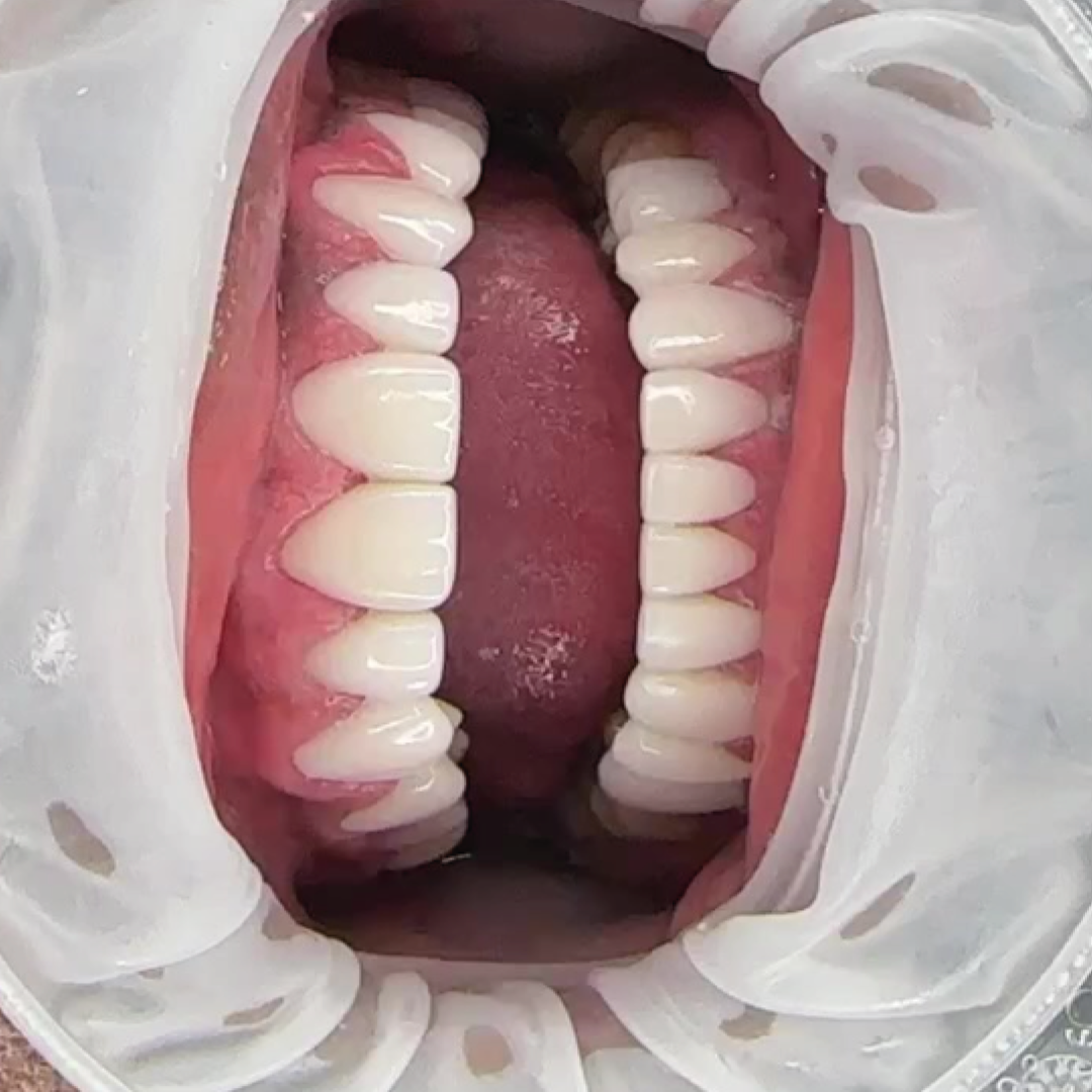 Smile design detail — Smile On result