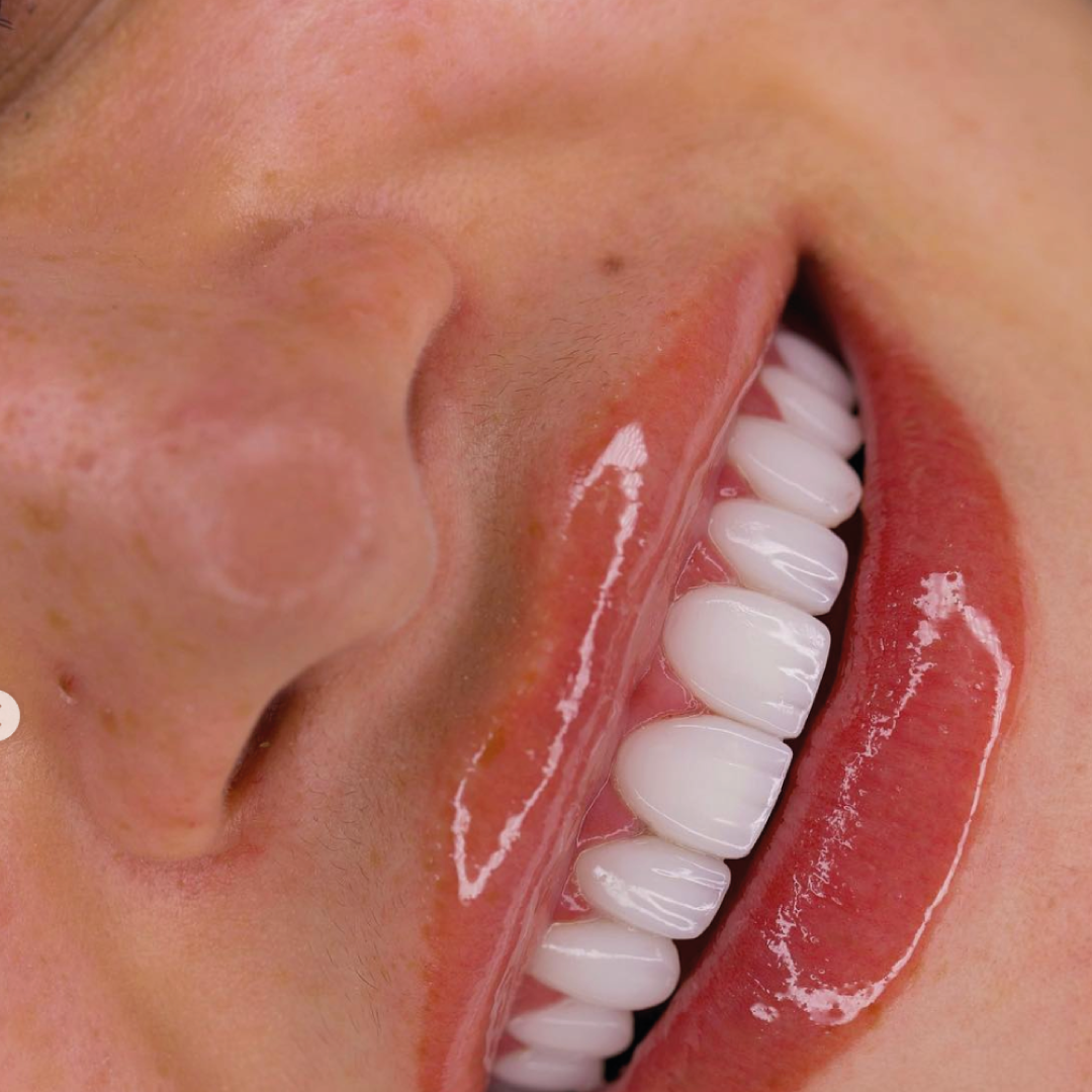 Smile design detail — Smile On result