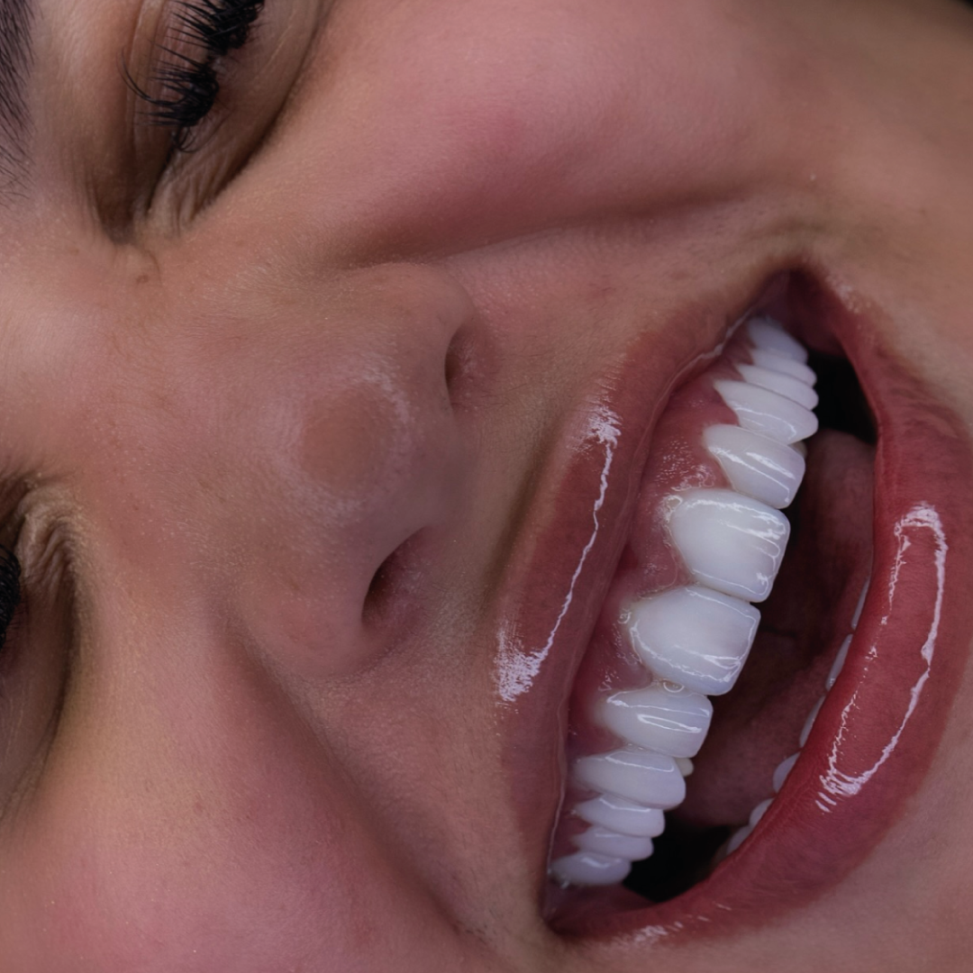 Smile design detail — Smile On result